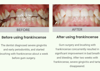 Unitein Toothpaste before and after